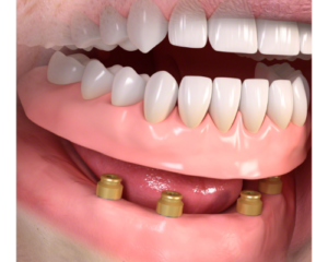 インプラントに連結するタイプの入れ歯