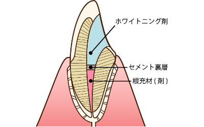 ウォーキングブリーチ、神経の死んだ歯の漂白